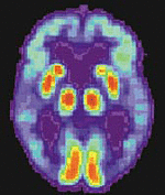 Positronen-Emissionstomografie eines Alzheimer-Patienten